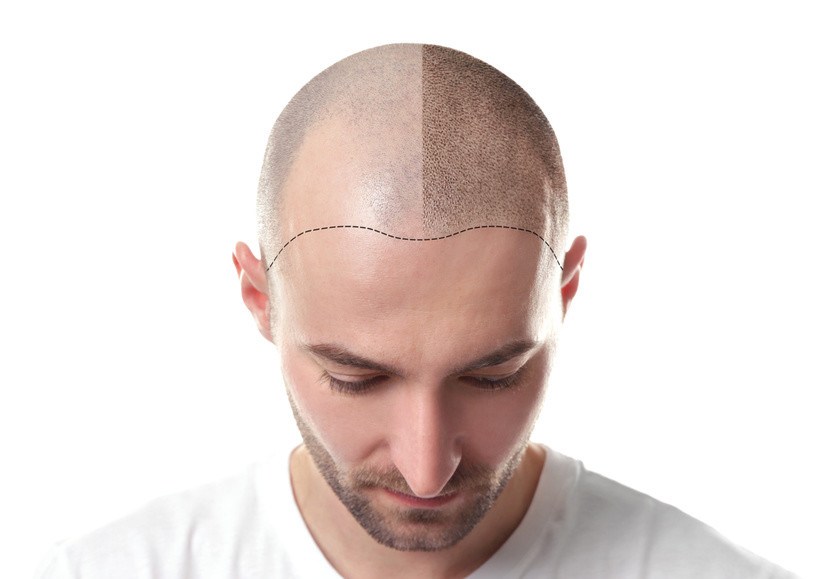 Eigenbluttherapie Haare bei Mann