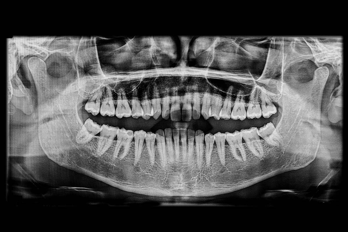 Nervlateralisation