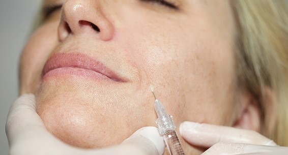Faltenbehandlung durch Unterspritzung
