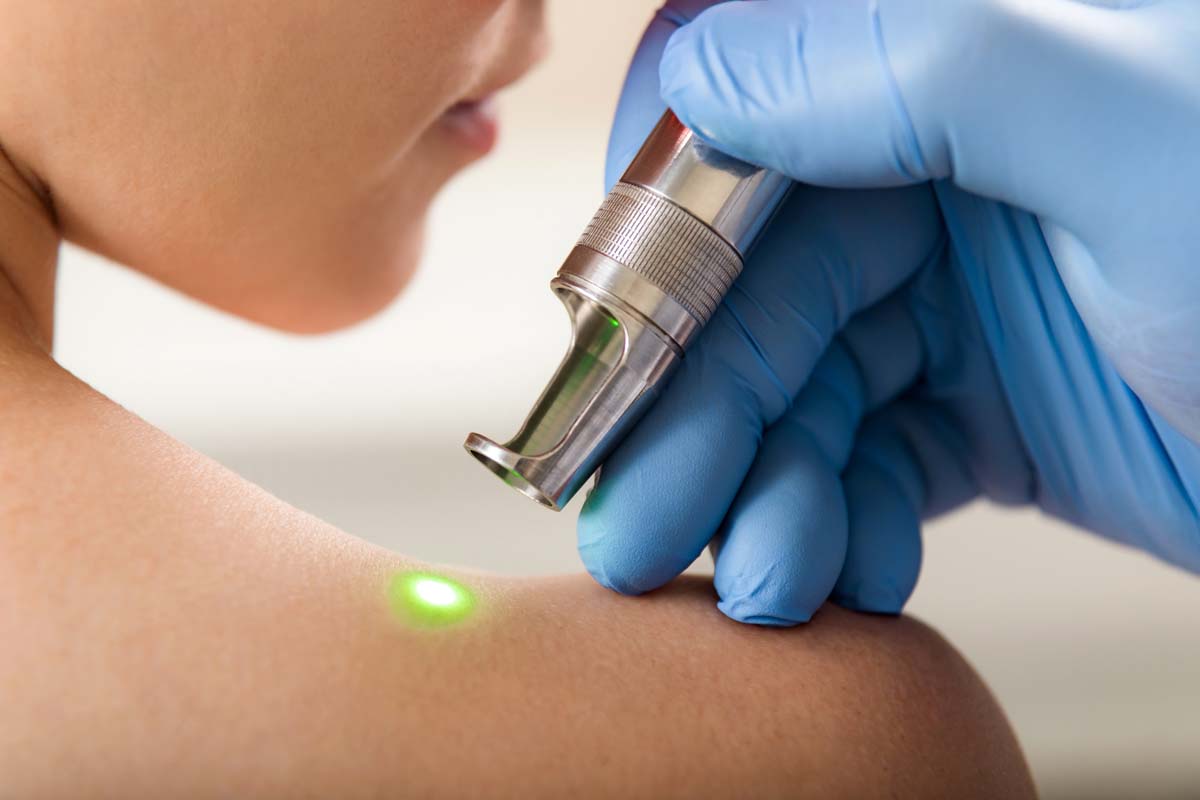 Removal of good-quality birthmarks and warts. The girl on a session laser therapy.